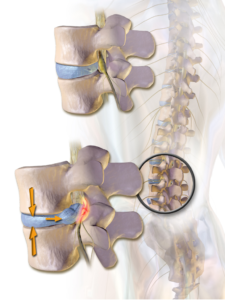 Chiropractic care for lower back pain bulging disc chiropractic care at American Chiroprators