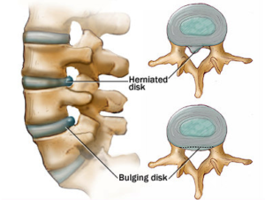 bulging disc chiropractic care