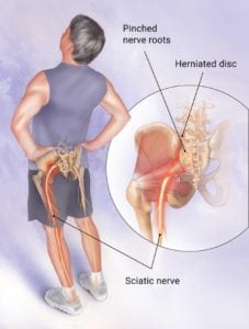 Can a Chiropractor Help With Sciatic Nerve Pain