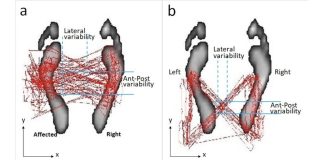 New Parkinson's procedure improves gait and back pain

