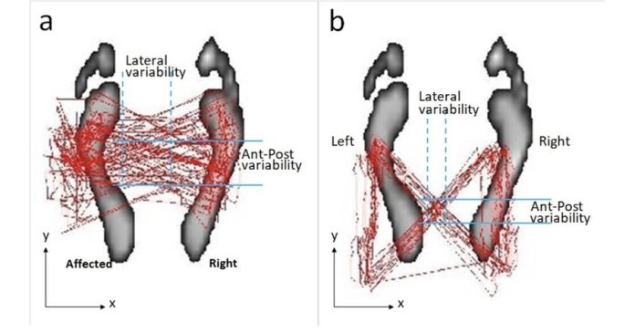 New Parkinson's procedure improves gait and back pain

