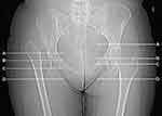 Anatomical features of sciatic and femoral nerves TCRM — Dove Medical Press