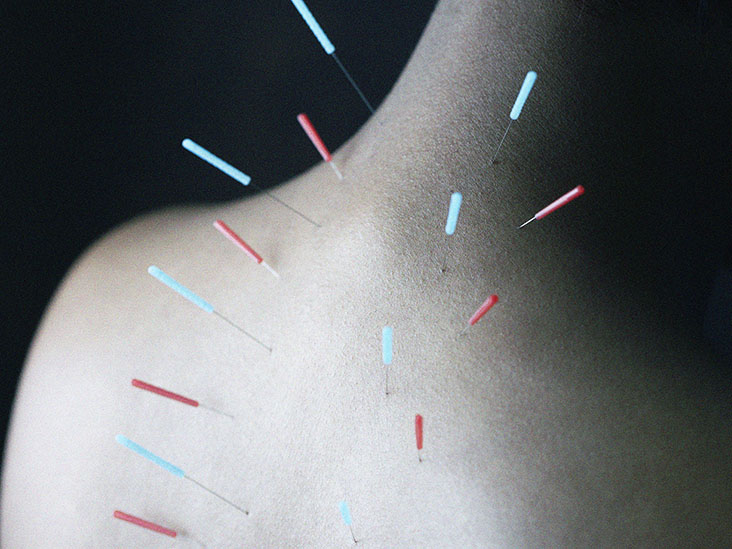 Acupuncture to treat neck discomfort Does it work? — Medical News Today