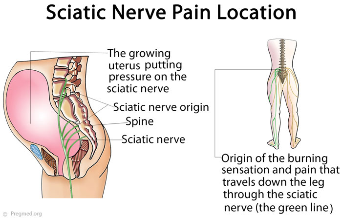 Do You Get Sciatica When Pregnant?