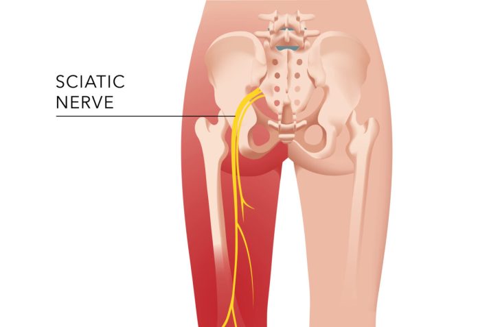 How I Recovered My Sciatica - The Epoch Times