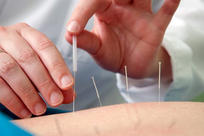 Are you suffering from headaches? A New Study Says Acupuncture May Help - WebMD