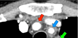 Linear neck pain and chronic cough caused by Takayasu Arteritis Cureus