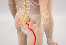 A new study has been conducted to determine OASIS treatment for sciatica people afflicted by sciatica. Australian Seniors News