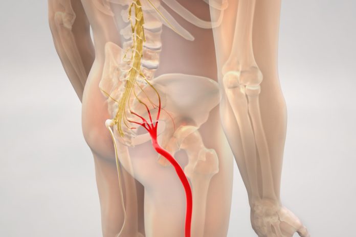 A new study has been conducted to determine OASIS treatment for sciatica people afflicted by sciatica. Australian Seniors News