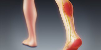 Can sciatica cause foot pain?