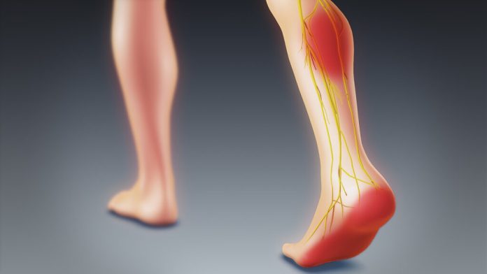 Can sciatica cause foot pain?