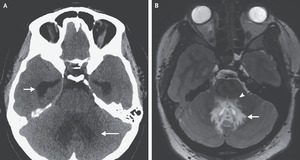 Case 25-2022: A woman aged 25 with Headache and blurred Vision | NEJM nejm.org