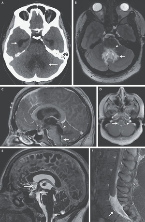 Case 25-2022: A woman aged 25 with Headache and blurred Vision | NEJM nejm.org