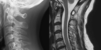 Cervical Implant Allergy with Chronic Neck Pain A Case Report Cureus