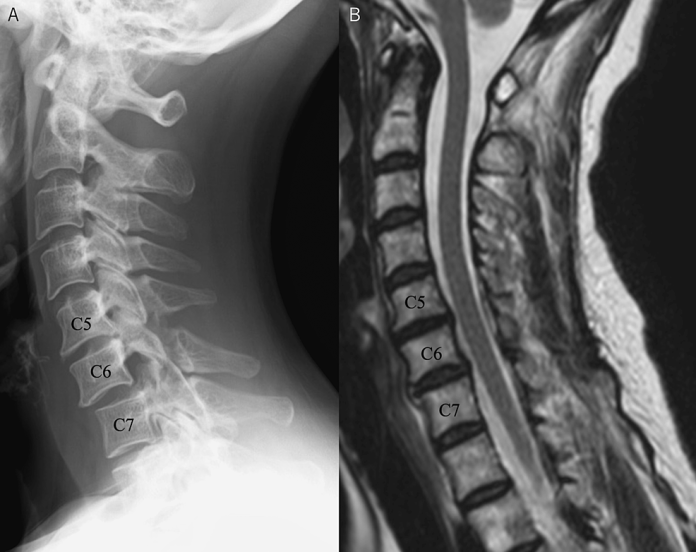 Cervical Implant Allergy with Chronic Neck Pain A Case Report Cureus