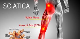 does ice help sciatica pain