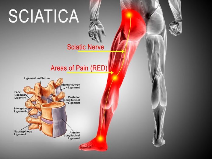 does ice help sciatica pain