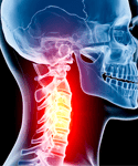 Postoperative Myeloradiculopathy Improvement for Patients Physician's Weekly Report