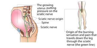 how can i help with my sciatica pain during pregnancy