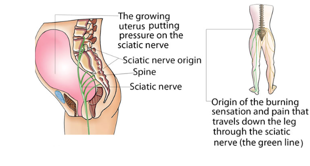 how can i help with my sciatica pain during pregnancy