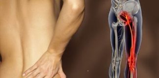 Can Endometriosis Cause Sciatica Pain