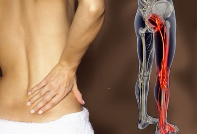 Can Endometriosis Cause Sciatica Pain
