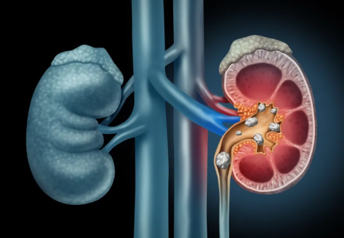 Can Kidney Stones Cause Sciatica