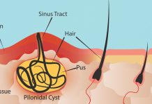 Can a Pilonidal Cyst Cause Back Pain