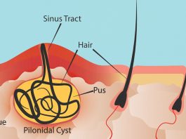 Can a Pilonidal Cyst Cause Back Pain