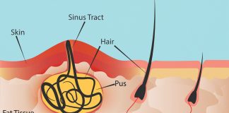 Can a Pilonidal Cyst Cause Back Pain