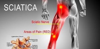 Can sciatica cause calf pain