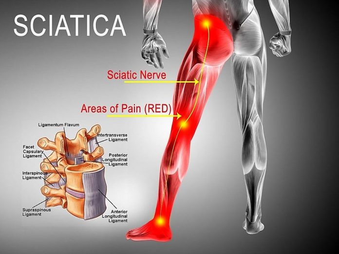 Can sciatica cause calf pain