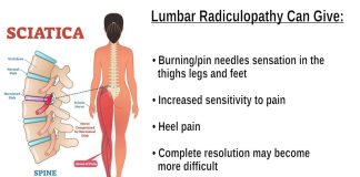 can sciatic nerve cause plantar fasciitis