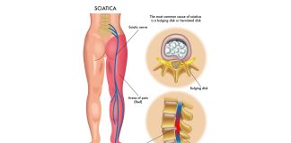 how does sciatica cause groin pain