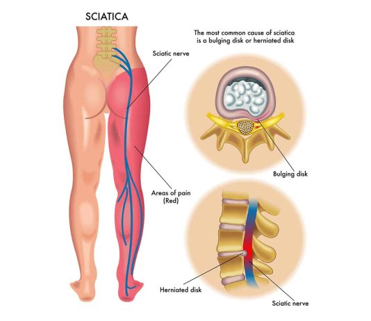 how does sciatica cause groin pain