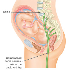 How To Get Rid Of Sciatica Pain During Pregnancy