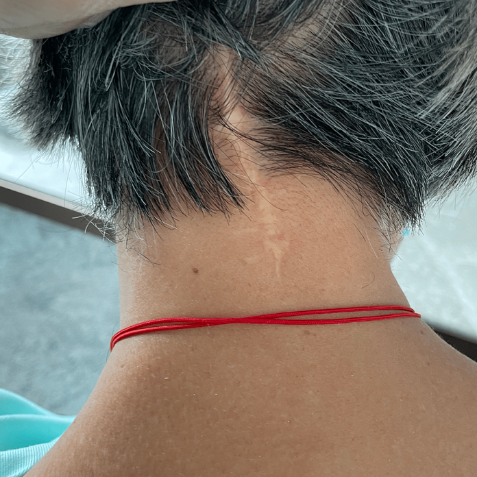 Improved Neck Pain Following Posterior Alantoaxial ... Cureus