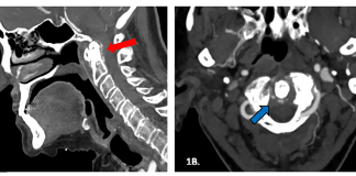 Crowned Dens Syndrome: A challenging diagnosis for older adults who present with acute neck pain Cureus