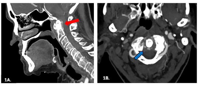 Crowned Dens Syndrome: A challenging diagnosis for older adults who present with acute neck pain Cureus